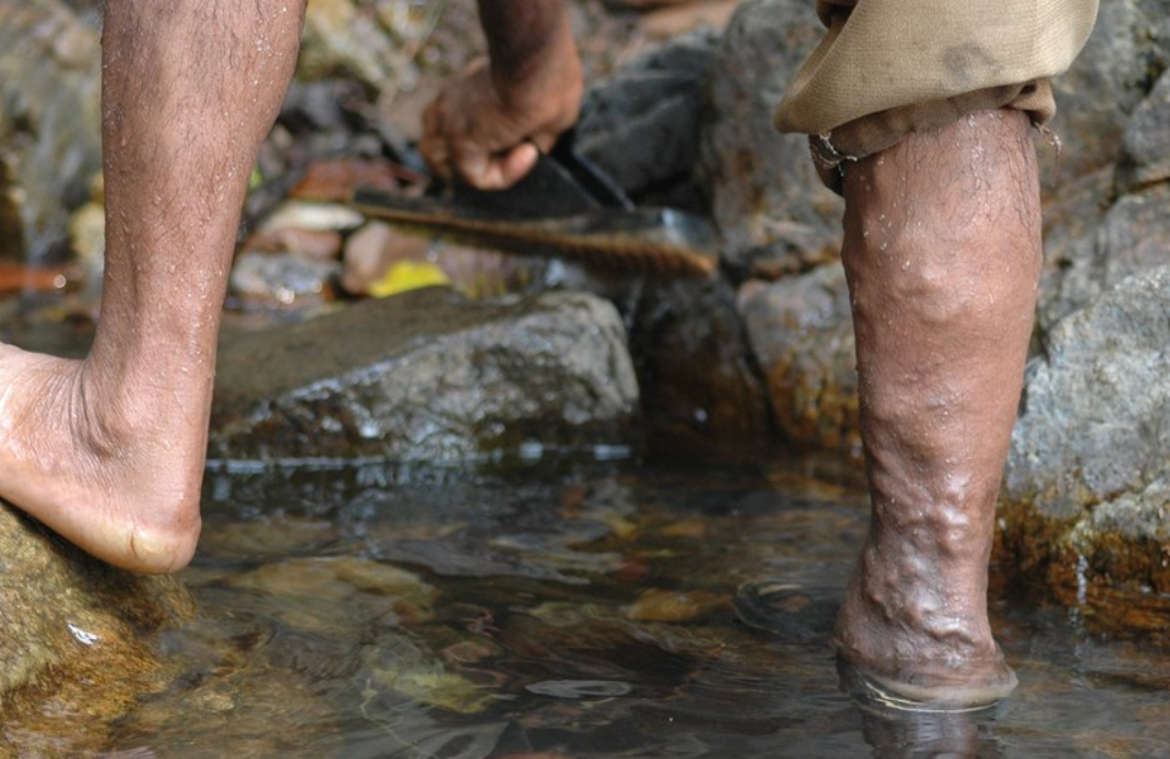 cum de a trata varicoza i eczema meniu pentru o saptamâna cu varicoza